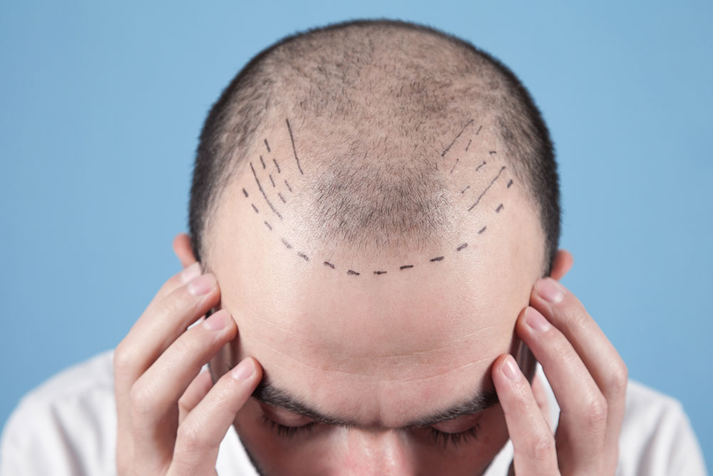 Hair Transplant – Techniques, Costs, and More