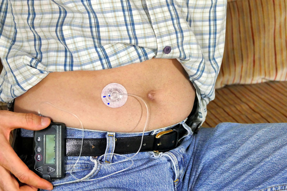 Insulin Pumps for Type 1 Diabetes – Types and Benefits